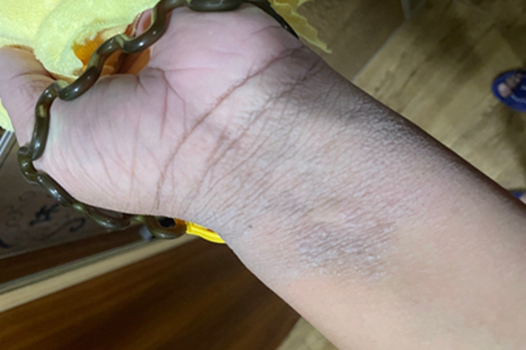 窝状角质松解症手腕皮肤粗糙图 窝状角质松解症手腕皮肤粗糙图