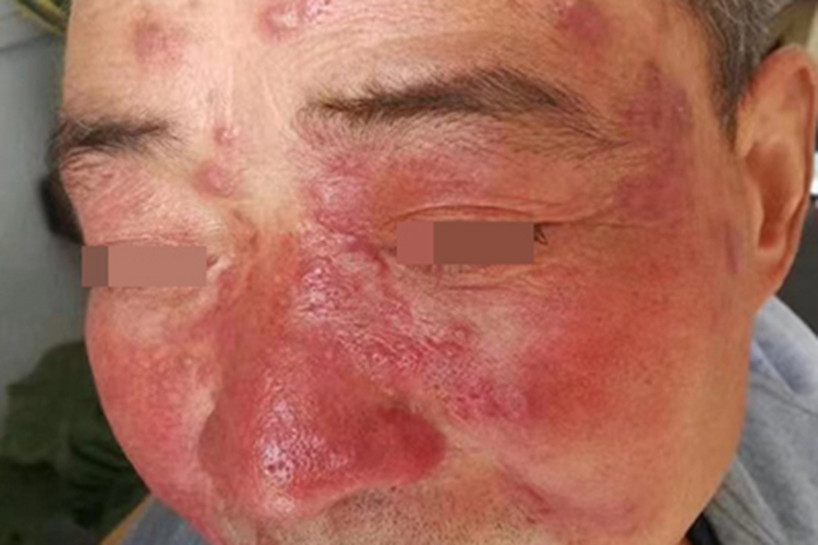 丘疹脓疱型玫瑰痤疮红斑图