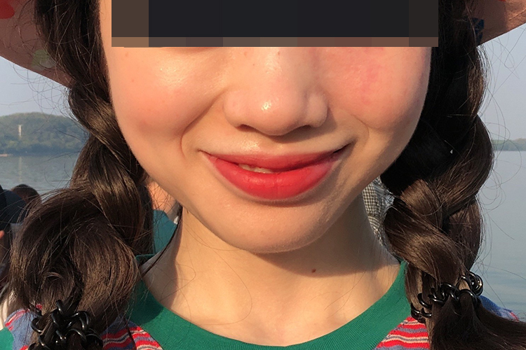 585激光后紫癜几乎消失图 585激光后紫癜几乎消失图