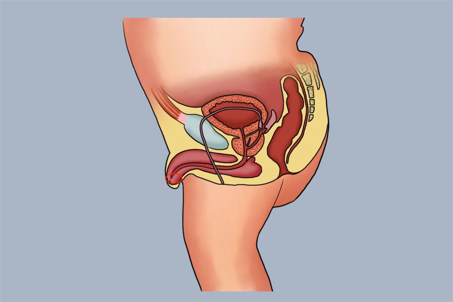 宝宝尿道口粘连图
