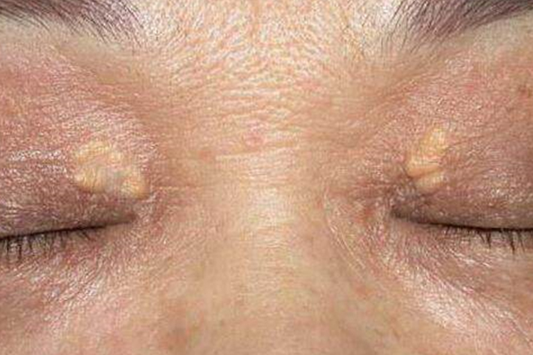 黄色瘤图 黄色瘤图