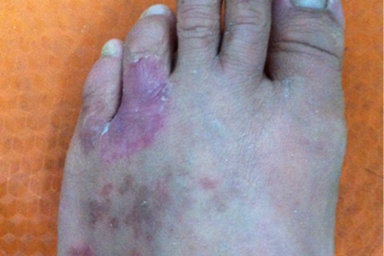 浸渍糜烂型足癣脚趾发红图