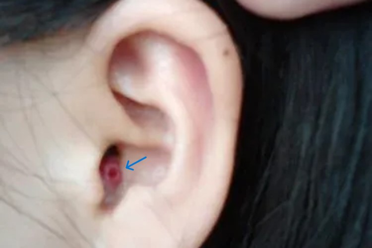 耳朵里毛囊炎图 耳朵里毛囊炎图