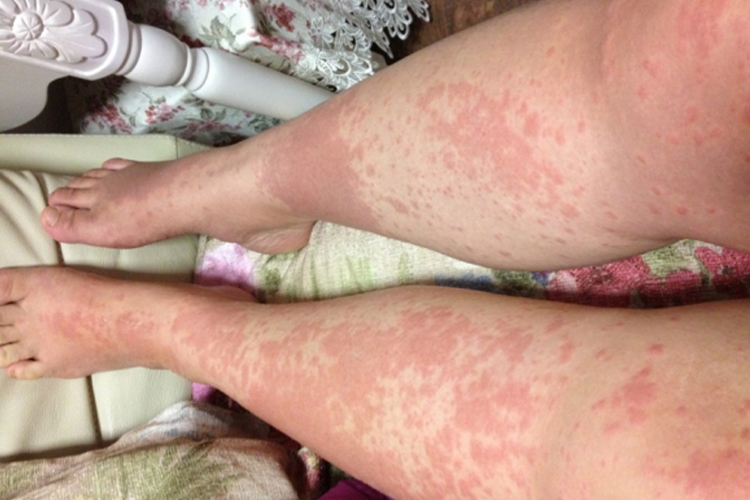 急性湿疹小腿红点图