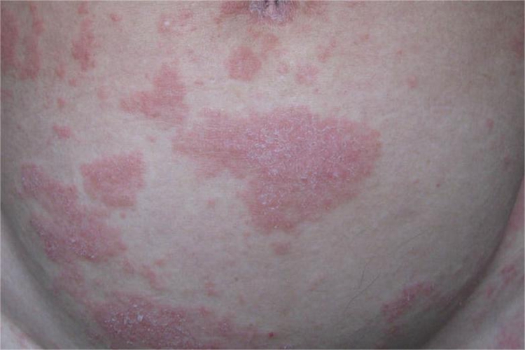 副银屑病腹部症状图 副银屑病腹部症状图
