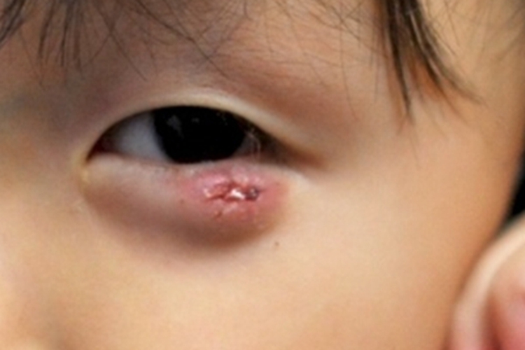 霰粒肿眼睑血痂图