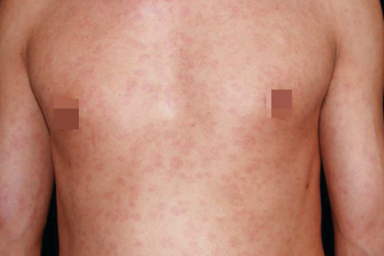 斑疹性梅毒疹全身红斑图 斑疹性梅毒疹全身红斑图