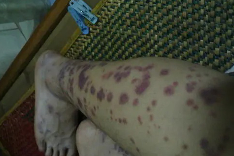 臭虫叮咬紫癜图片 臭虫叮咬紫癜图片