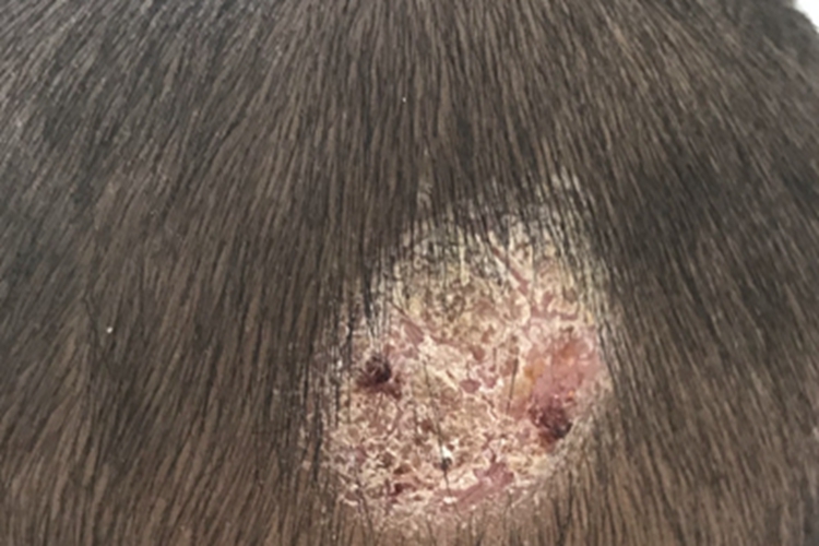 黄癣症状图 黄癣症状图