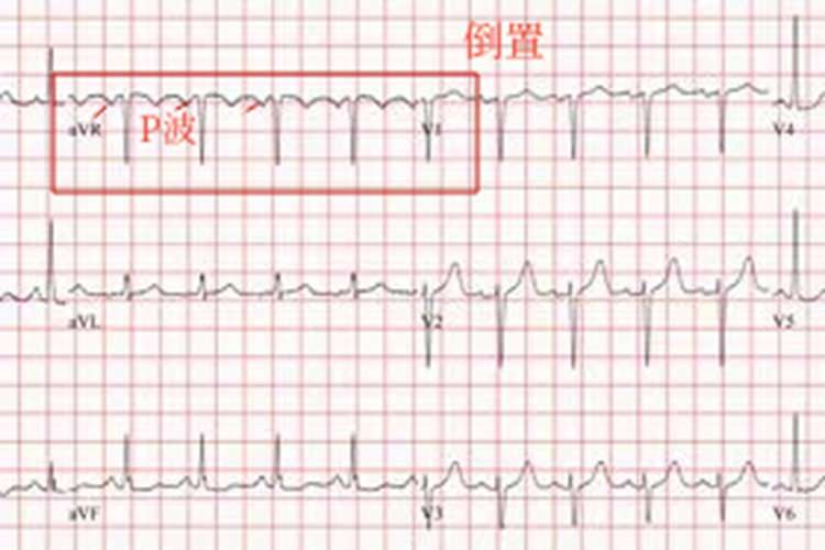 窦性心动过速心电图 窦性心动过速心电图