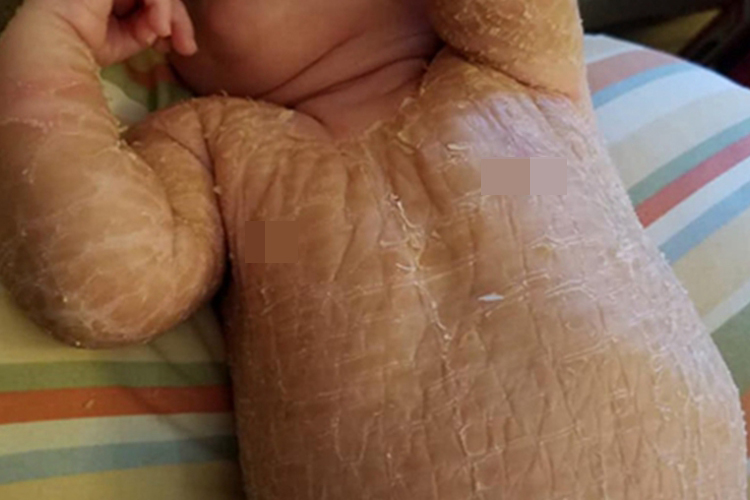 鱼鳞病全身脱屑图 鱼鳞病全身脱屑图