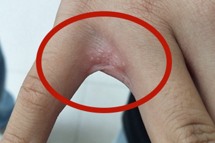 急性湿疹手指缝症状图