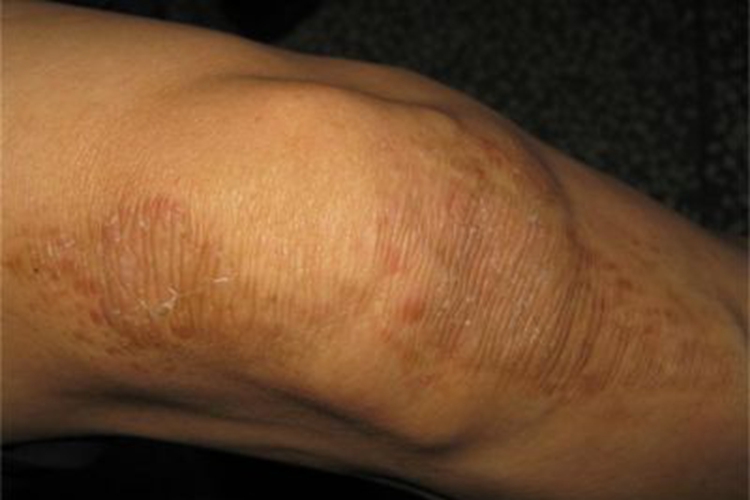 症状性苔藓样疹膝盖症状图