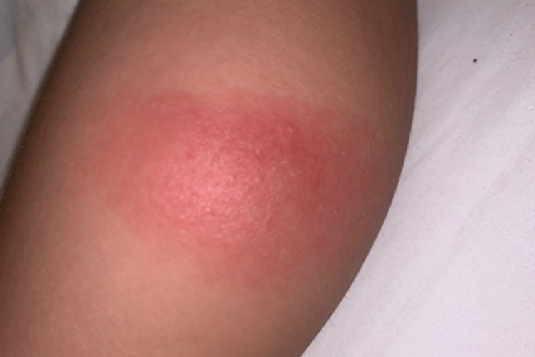 钩蚴性皮炎小腿红斑图