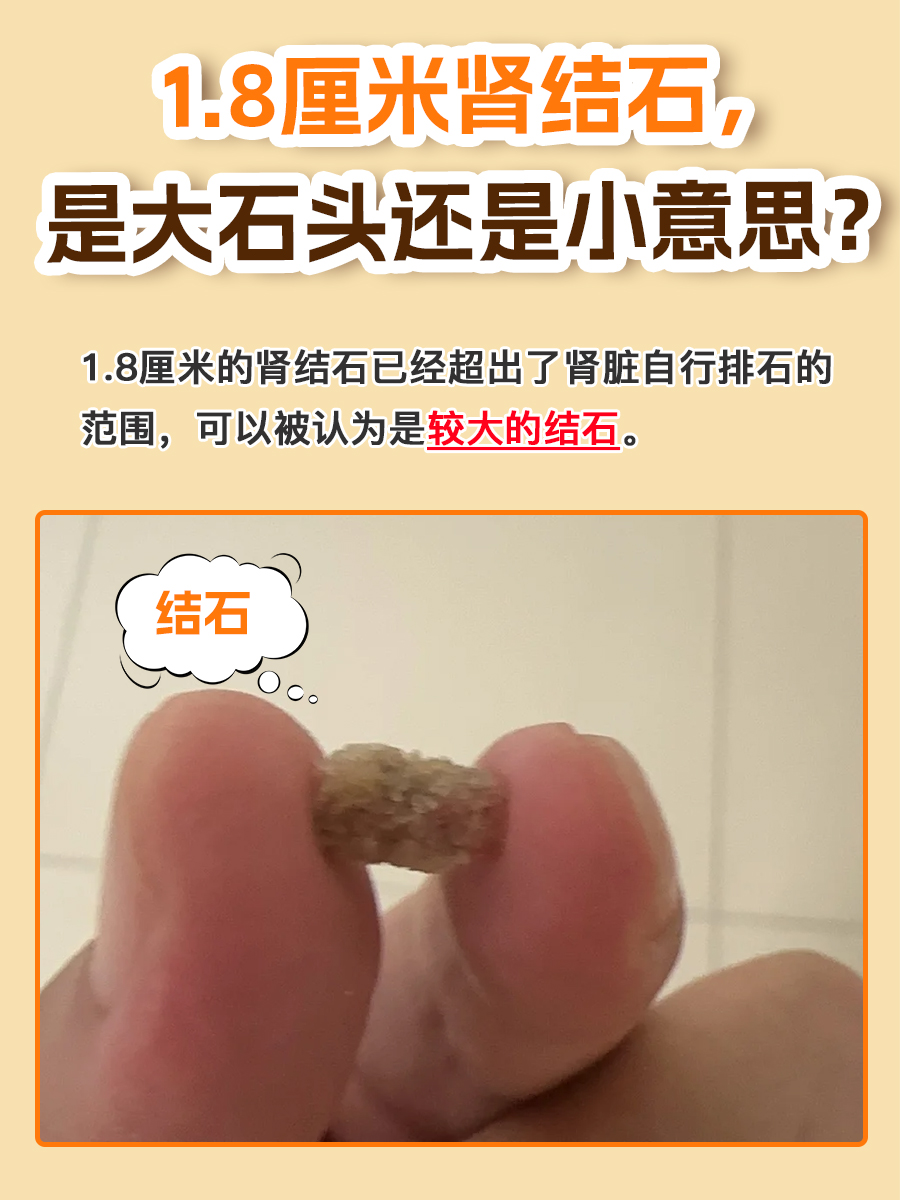 1.8厘米肾结石，是大石头还是小意思？