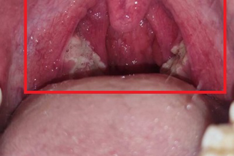 脓毒型猩红热症状图