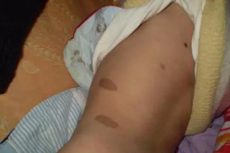 孩子身上咖啡斑图