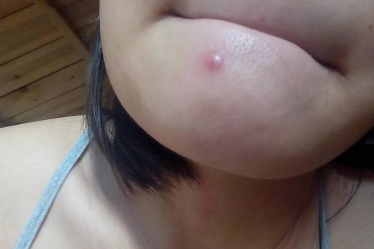 下巴颏下面疖肿图