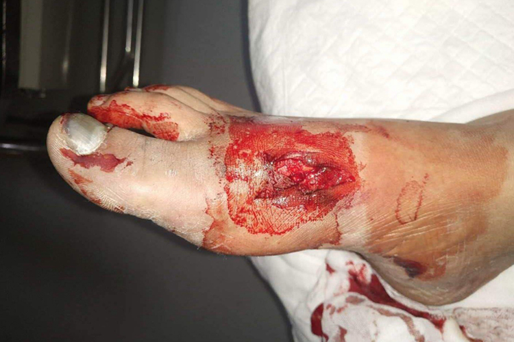 治疗脚被砸伤后,若出现闭合性创伤,应及时把受伤或骨折的脚固定起来