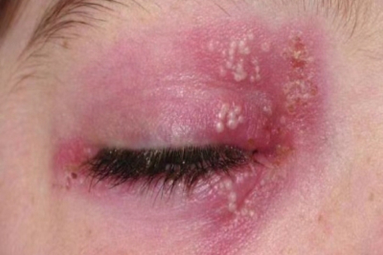 眼睑热性疱疹眼周症状图 眼睑热性疱疹眼周症状图