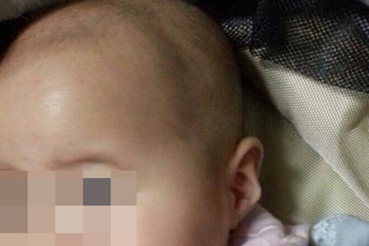 新生儿佝偻病凸出图 新生儿佝偻病凸出图