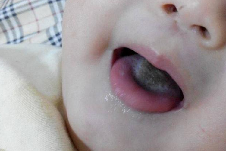 饮食积滞舌苔发黑图 饮食积滞舌苔发黑图