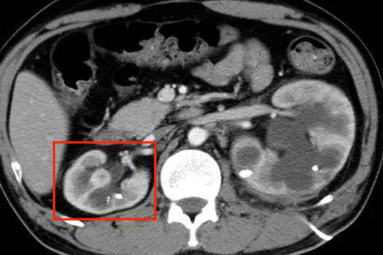 肾压迫性萎缩影像图