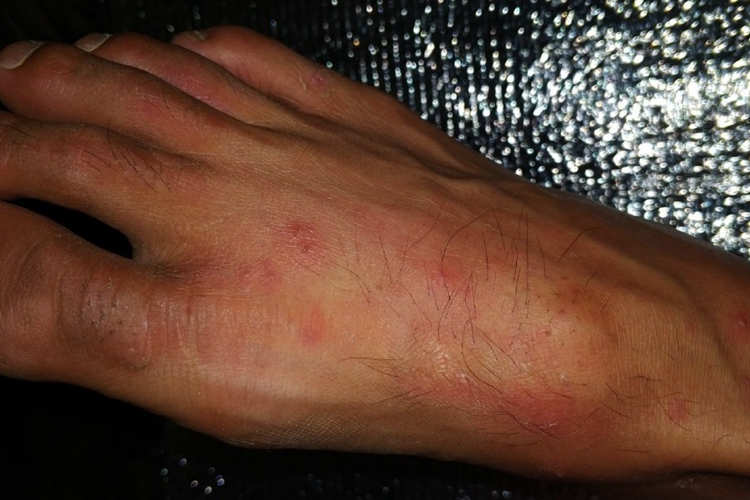 蚁蜇伤脚背结痂图 蚁蜇伤脚背结痂图