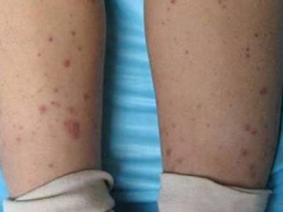 先天性风疹综合征小腿密密麻麻小红点图.jpg