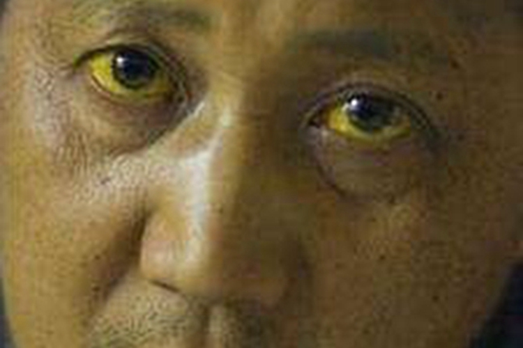 肝硬化面部发黄图