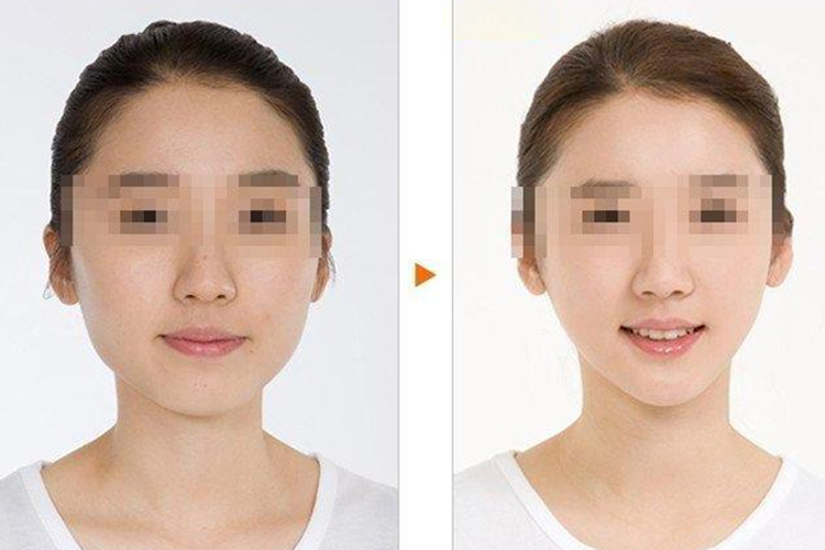 瘦脸针前后对比图 瘦脸针前后对比图