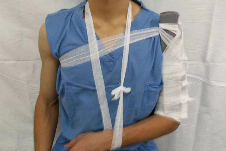 肱骨骨折两块夹板固定图