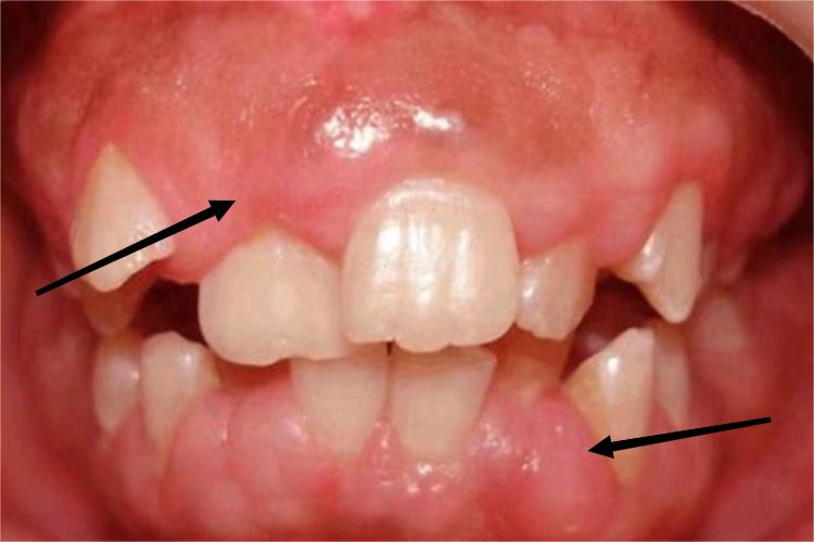 牙龈纤维瘤病肿图
