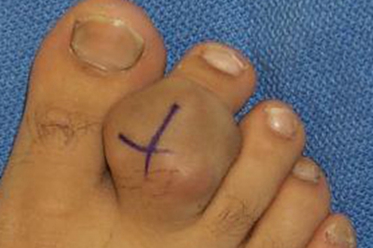 腱鞘巨细胞瘤脚趾肿块图