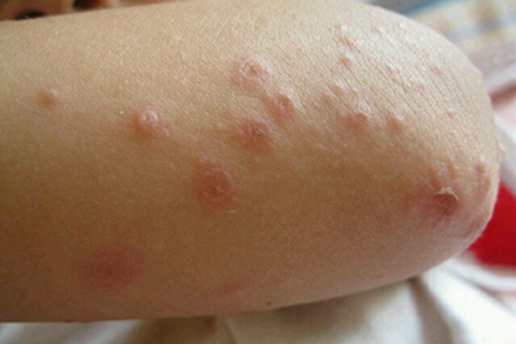 水痘肘部长很多小红疙瘩图 水痘肘部长很多小红疙瘩图