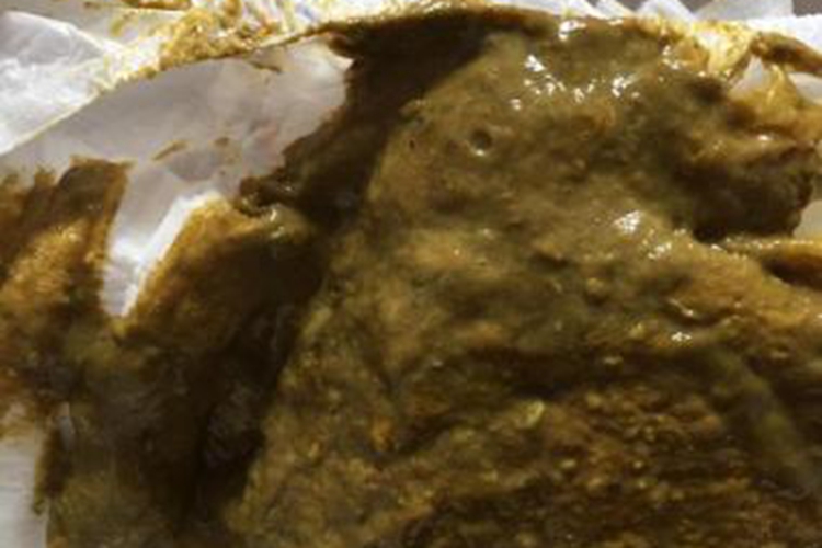 伪膜性肠炎黄绿色稀便图