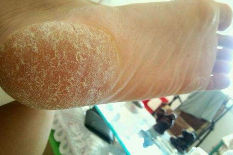 足癣脚部皮肤粗糙图