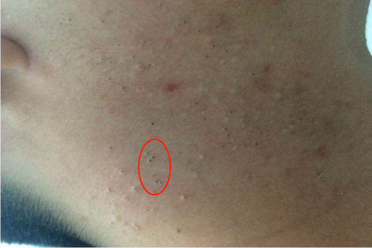 脖子上长黑头粉刺图 脖子上长黑头粉刺图