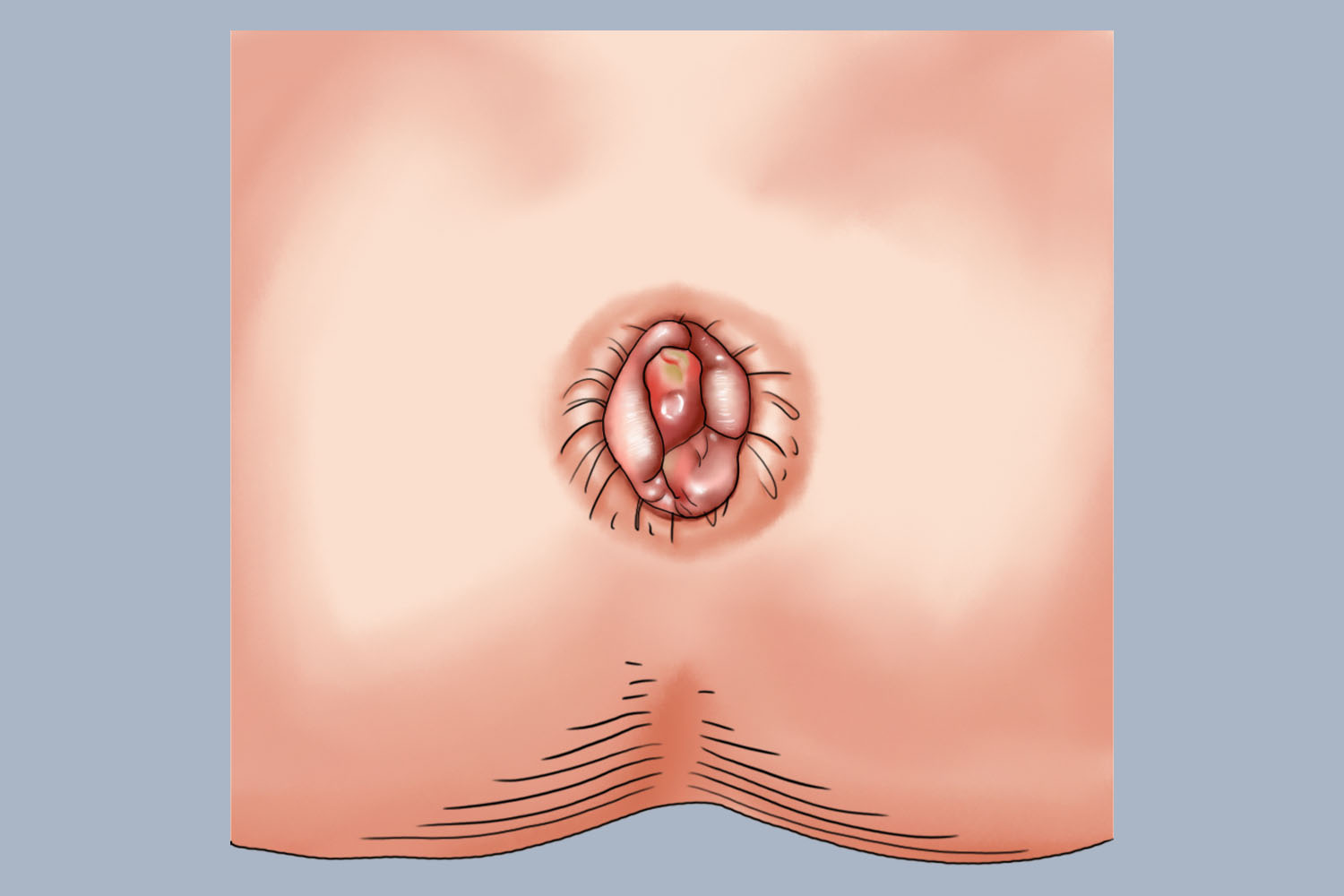 Ⅲ度内痔脱出图 Ⅲ度内痔脱出图