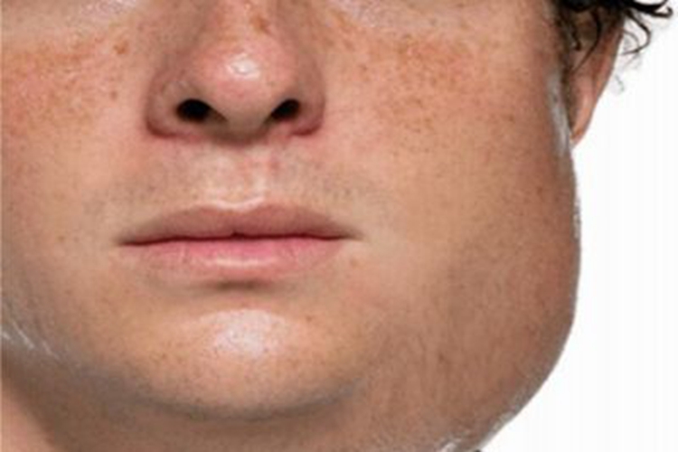 慢性阻塞性腮腺炎面部症状图 慢性阻塞性腮腺炎面部症状图