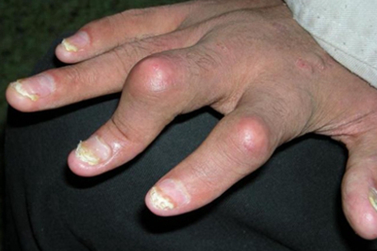 银屑病关节炎手部畸形图