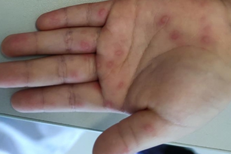 手足口病手部小疙瘩图 手足口病手部小疙瘩图