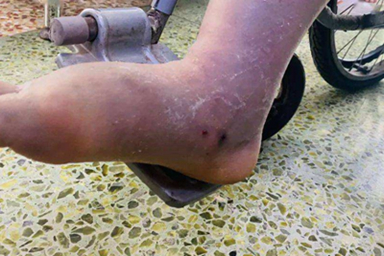 蛇咬伤脚背症状图