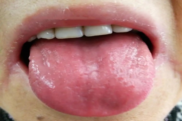 舌红无苔图 舌红无苔图