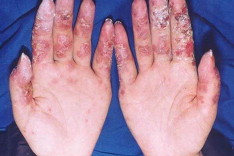 亚急性皮肤型红斑狼疮症状图