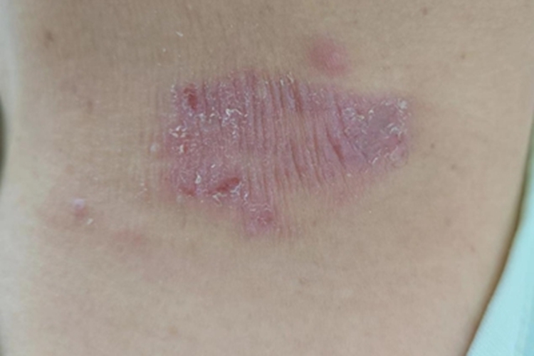 局限性神经性皮炎皮肤增厚图