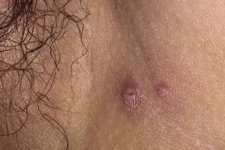 小孩腋下传染性软疣图