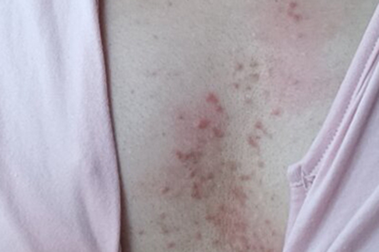 亚急性湿疹胸部斑图