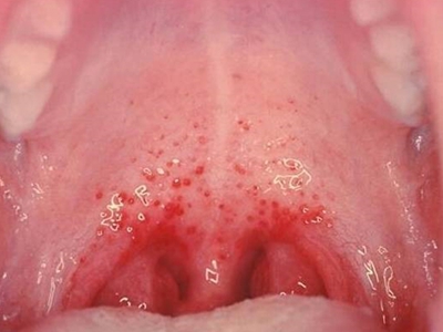 疱疹性咽峡炎咽峡充血有出血点图.jpg