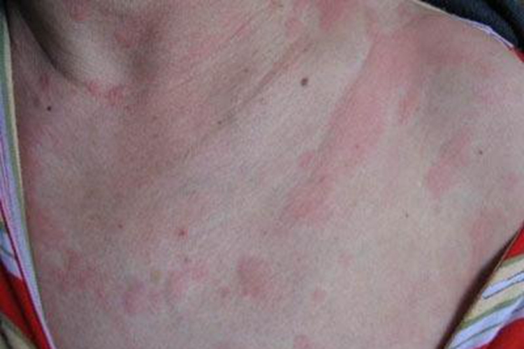 冷接触性荨麻疹图 冷接触性荨麻疹图